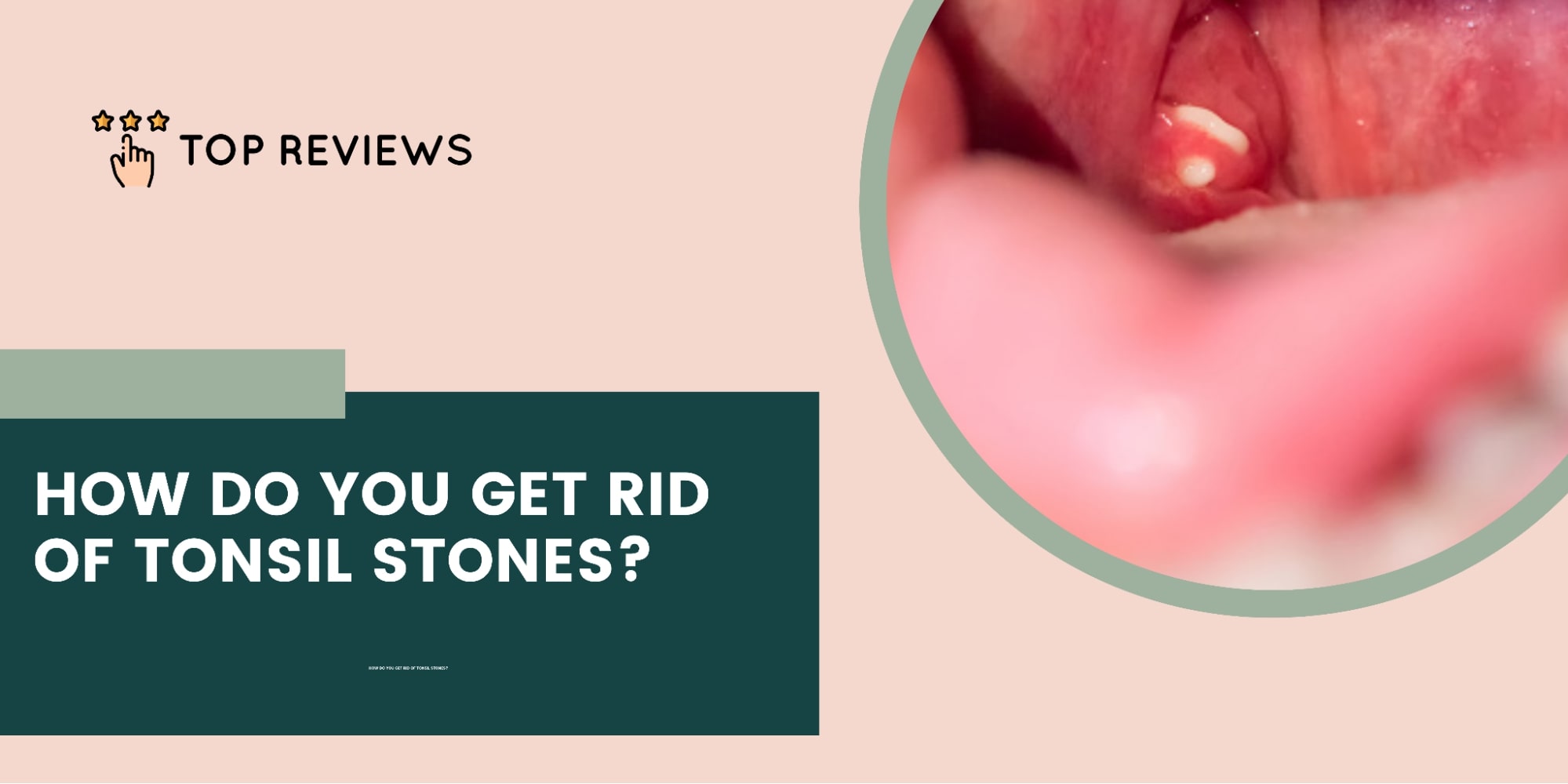 How do you get rid of tonsil stones